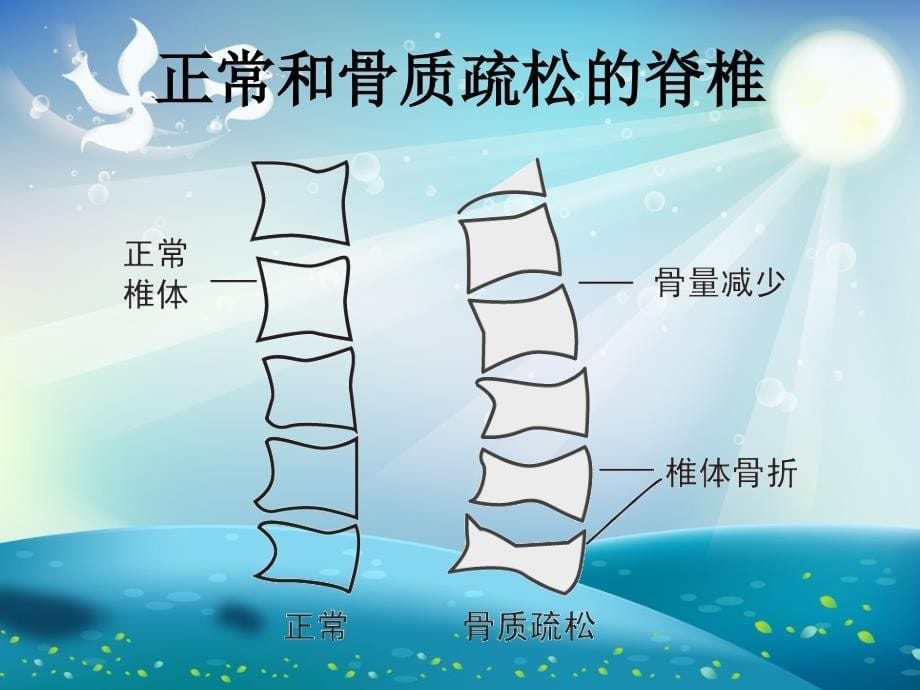 骨关节疾病防治新概念ppt课件_第5页