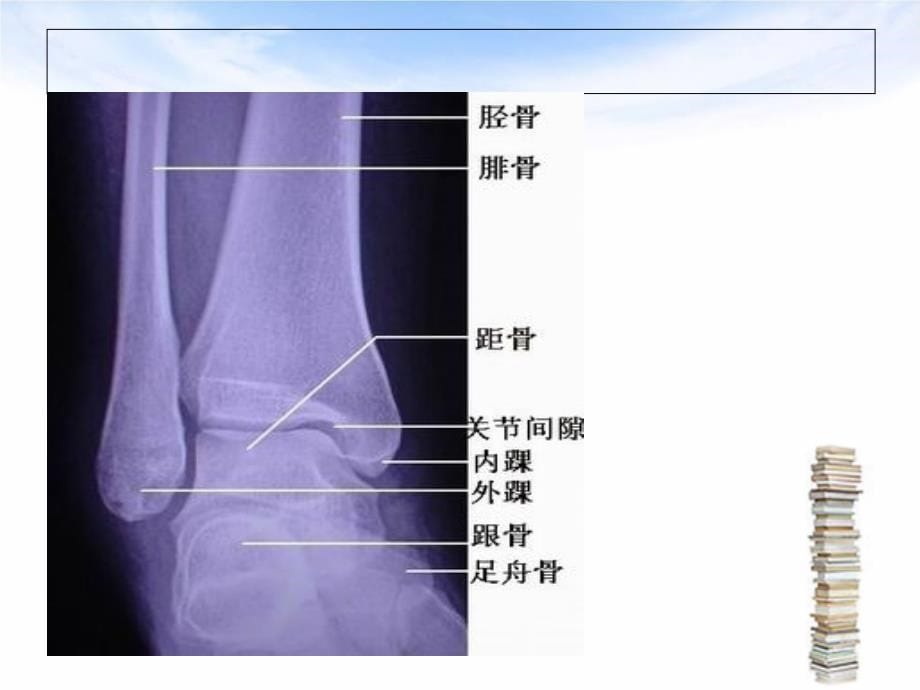 踝关节骨折的围手术期护理ppt课件_第5页