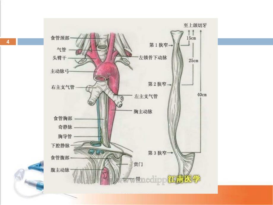 食管术后吻合口瘘的观察及护理_第4页