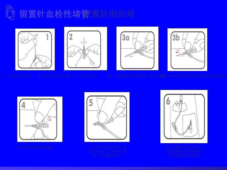 关于静脉留置针血栓性堵管的主要原因和对策措施PP课件_第5页