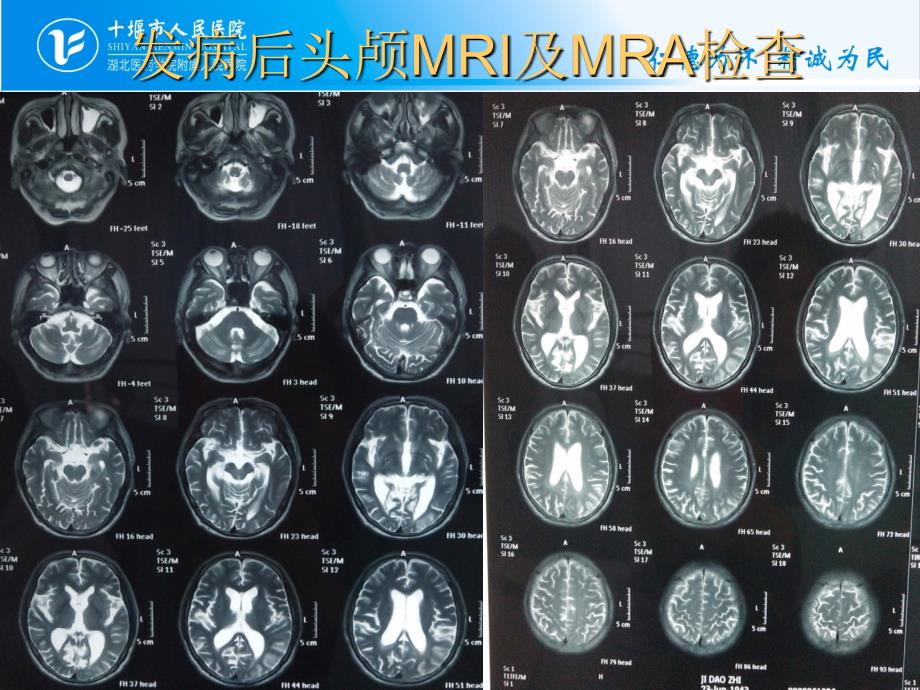 脑梗死出血性转化_第3页