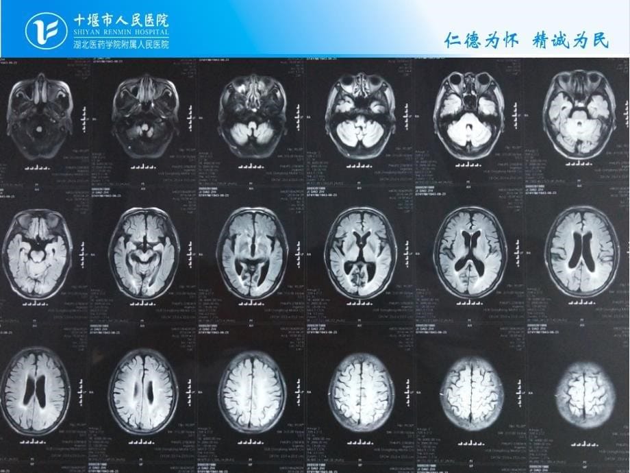 脑梗死出血性转化_第5页