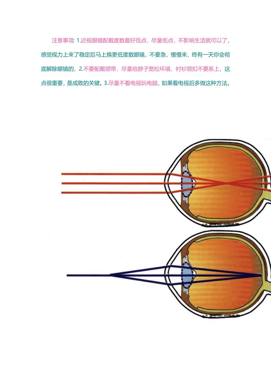 真正根治高度近视眼的方法.doc_第2页