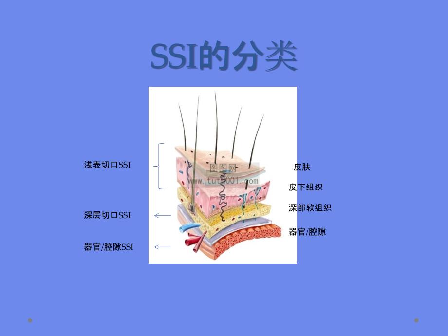 SSI的预防与控制_第4页