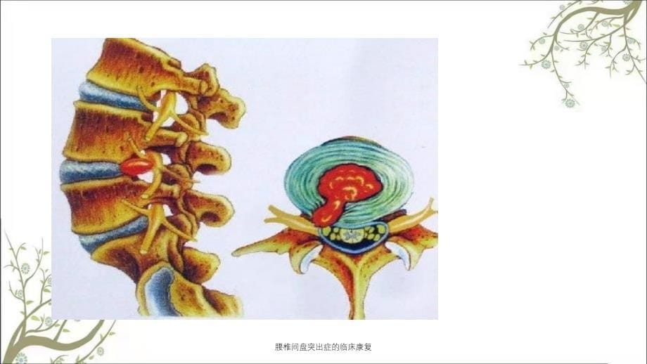 腰椎间盘突出症的临床康复课件_第5页