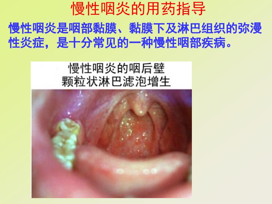 慢性咽炎的用药指导课件_第1页