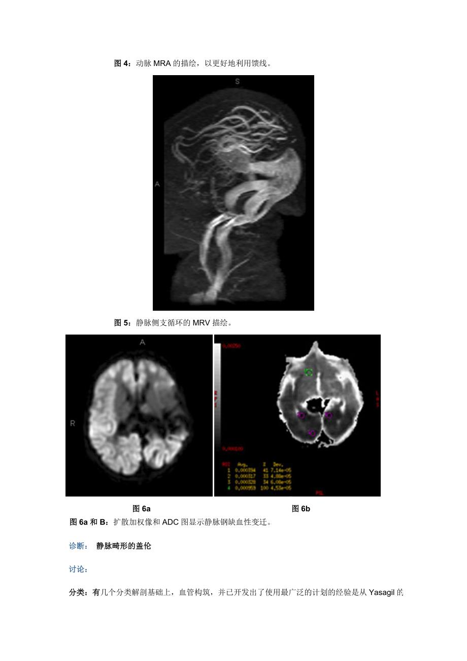 大脑大静脉畸形.doc_第4页