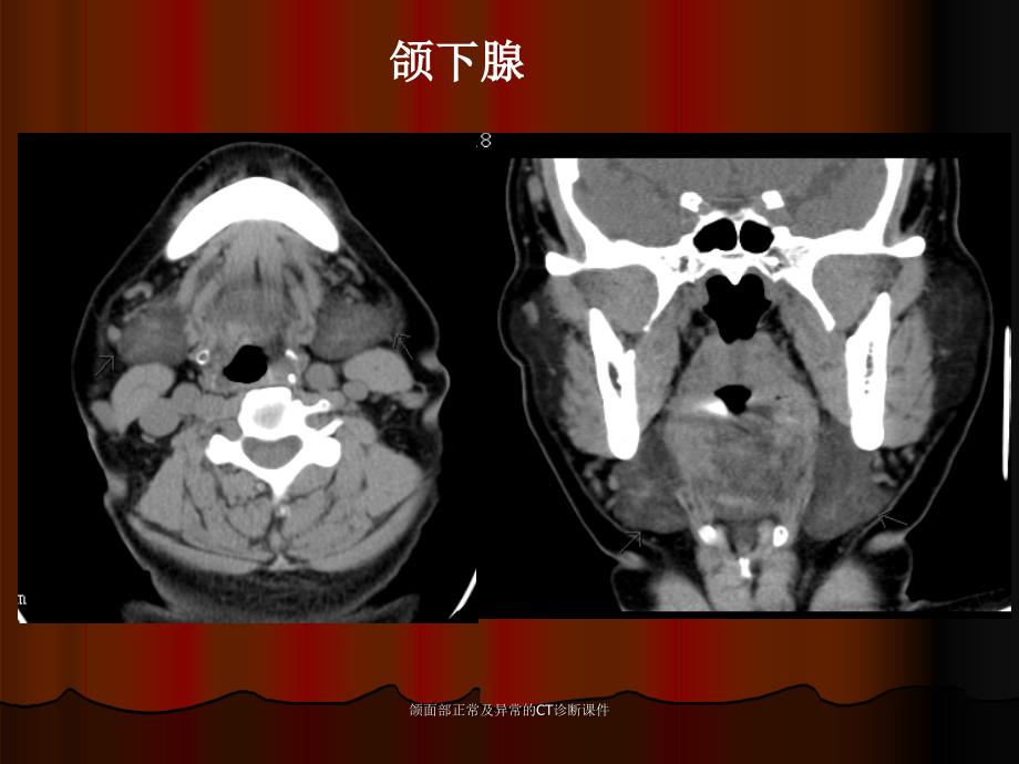 颌面部正常及异常的CT诊断课件_第4页