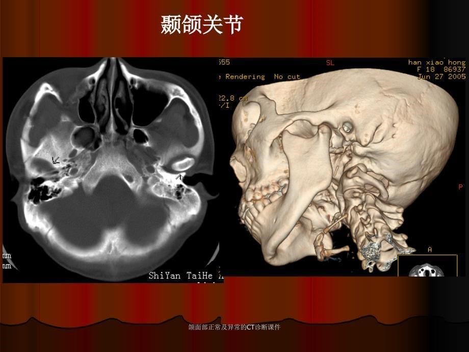 颌面部正常及异常的CT诊断课件_第5页