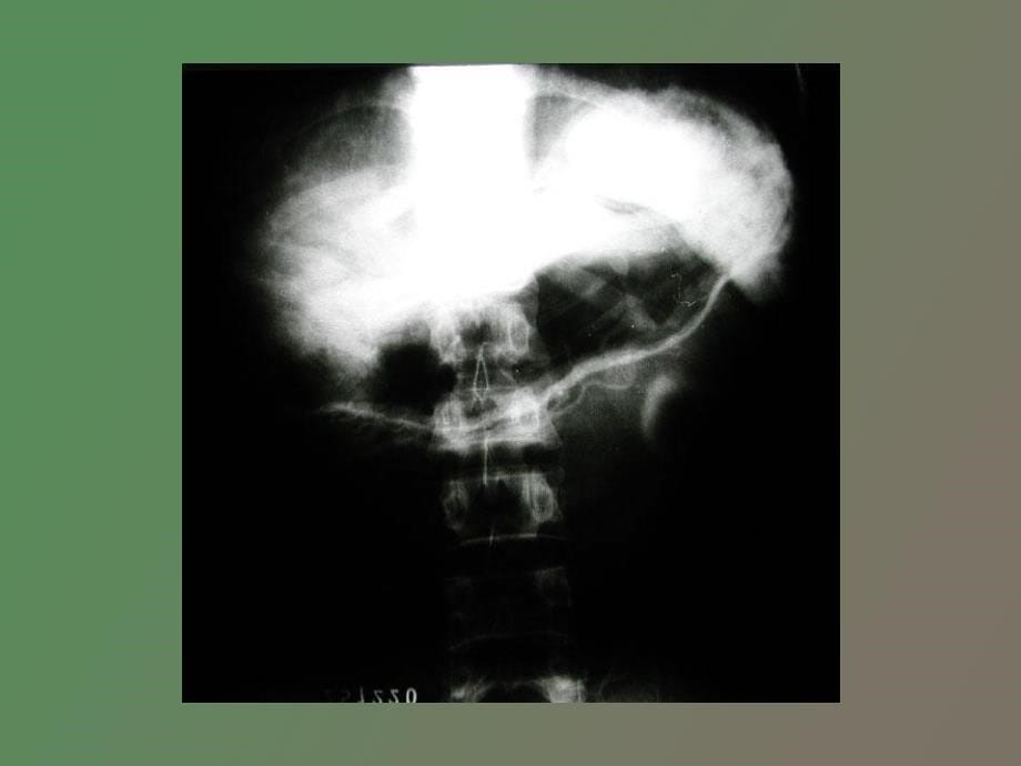 腹腔动脉造影_第5页