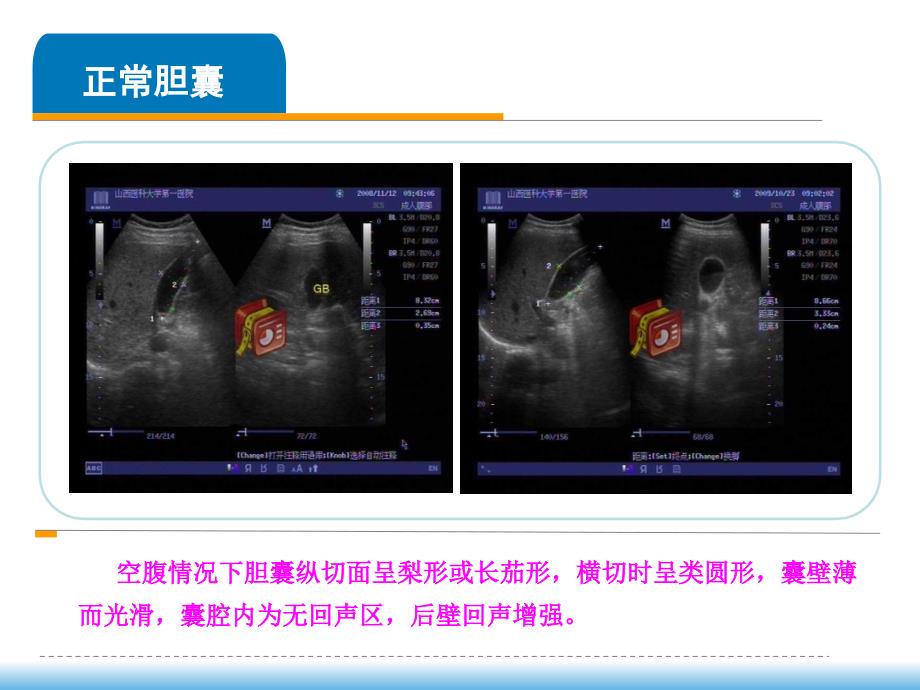 胆囊在感染性疾病中的超声表现山西医科大学第一医院郝晓云_第4页