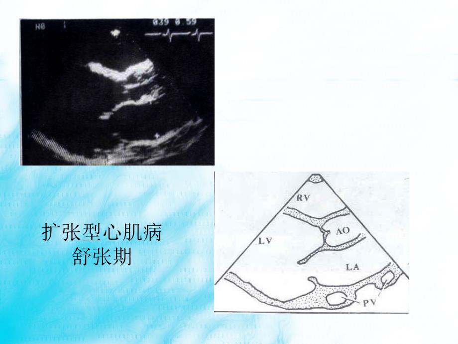 超声诊断学(第三版)：心肌病_第4页