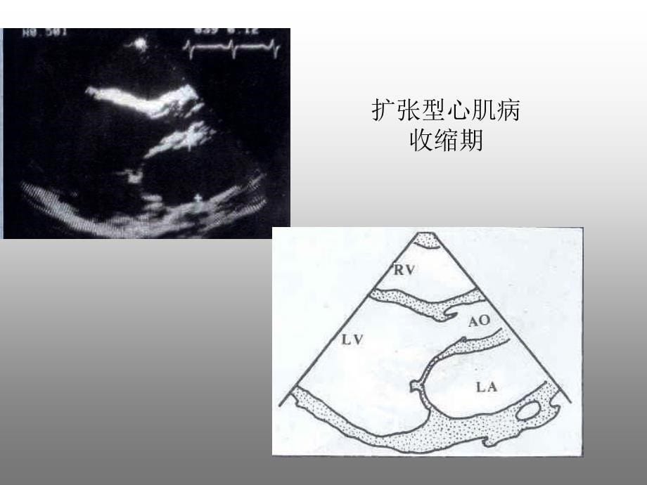 超声诊断学(第三版)：心肌病_第5页