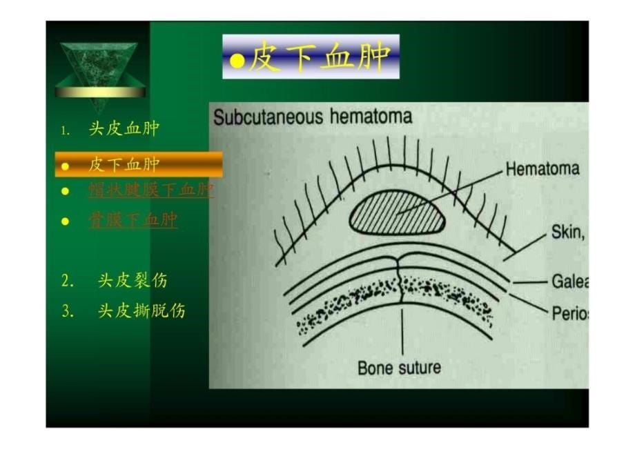 神经外科医学学ppt课件_第5页