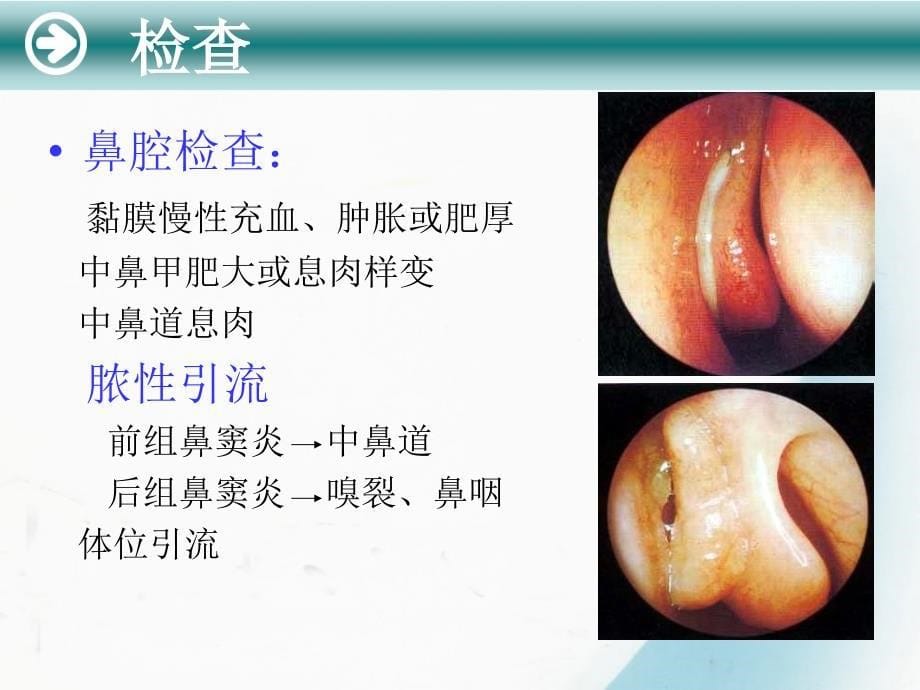 慢性鼻窦炎PPT课件_第5页