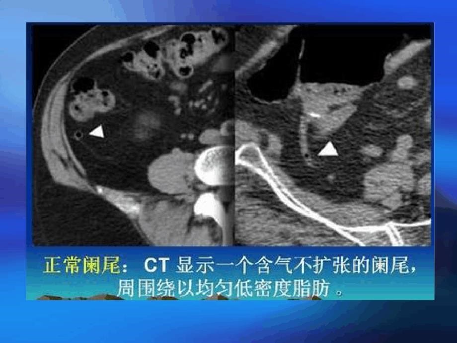 急腹症的CT诊断_第5页