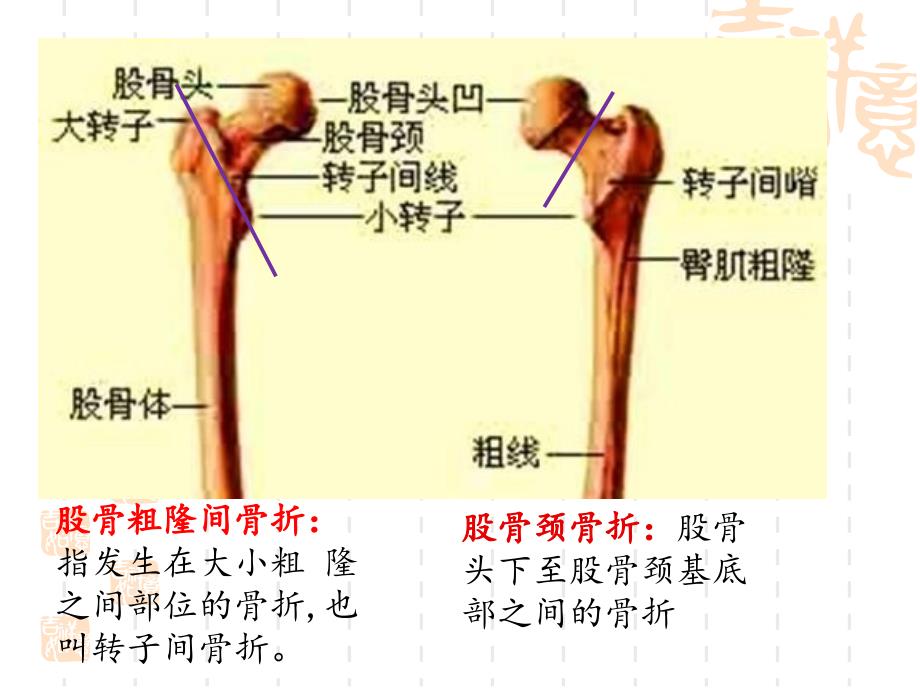 股骨近端骨折内固定选择策略孙欣_第2页