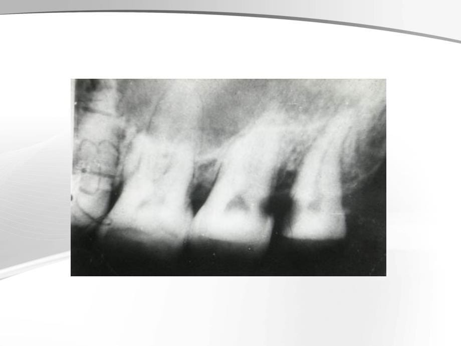 牙及牙周疾病影像学表现ppt参考课件_第5页