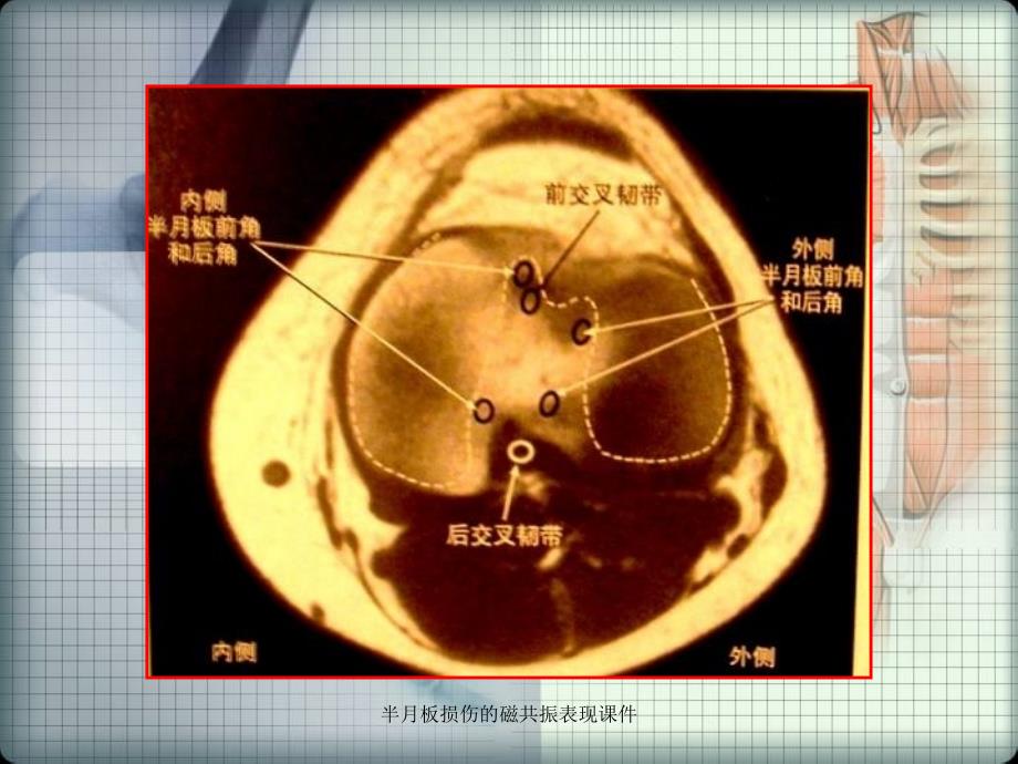 半月板损伤的磁共振表现课件_第3页