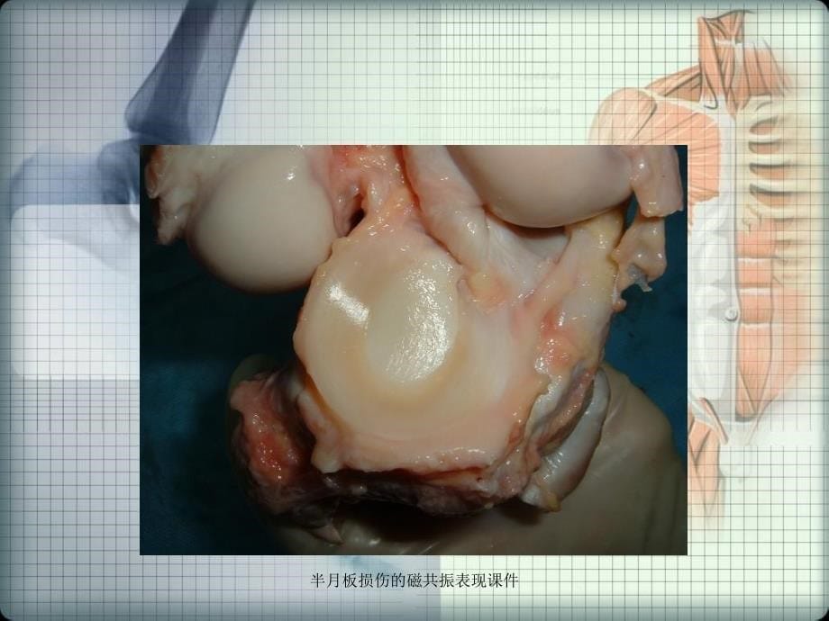 半月板损伤的磁共振表现课件_第5页