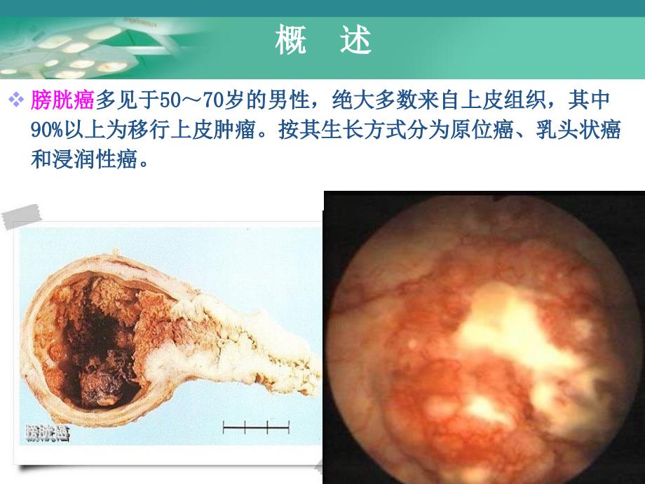 膀胱肿瘤病人的护理5_第3页