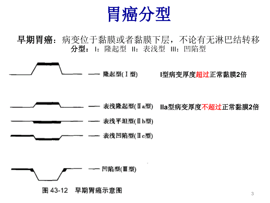 胃癌手术方式简介淋巴结分区PPT参考幻灯片_第3页