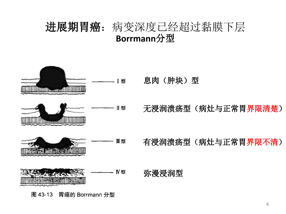 胃癌手术方式简介淋巴结分区PPT参考幻灯片_第4页