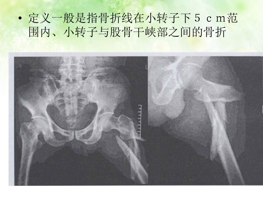 股骨转子下骨折_第2页