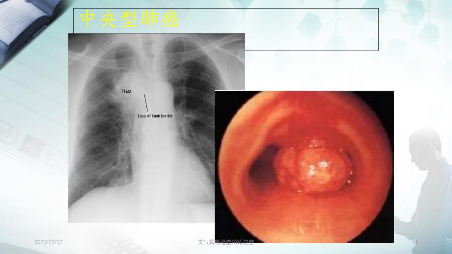 支气管镜检查的适应症精选PPT干货_第4页