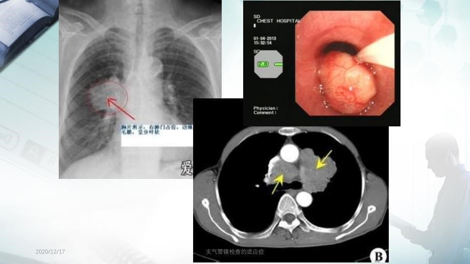 支气管镜检查的适应症精选PPT干货_第5页