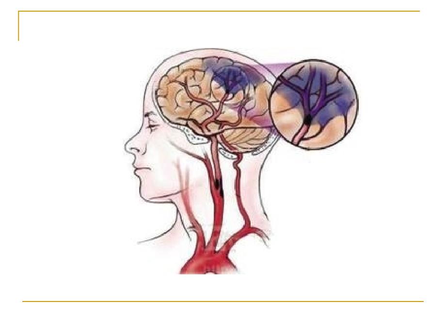 脑梗死教学课件_第2页