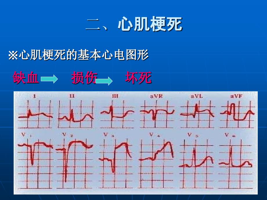 急性心肌梗死的心电图演变_第3页