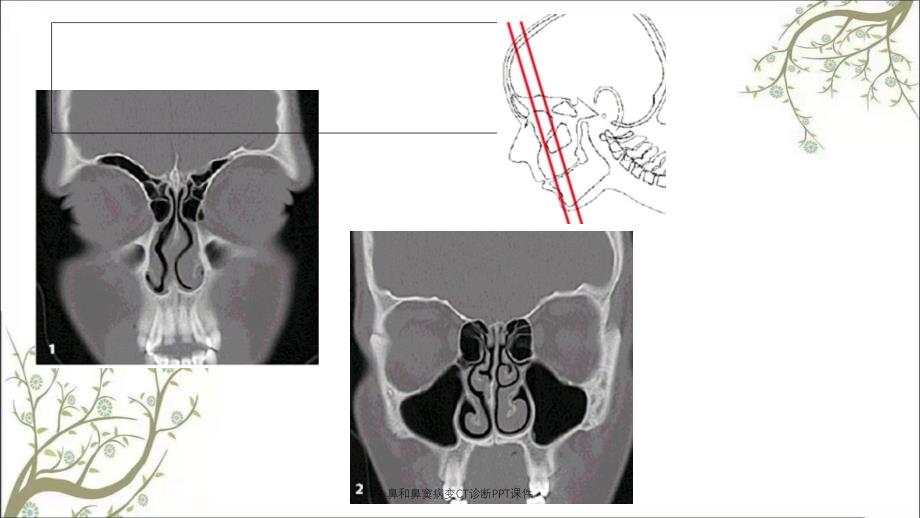 鼻和鼻窦病变CT诊断PPT课件_第4页