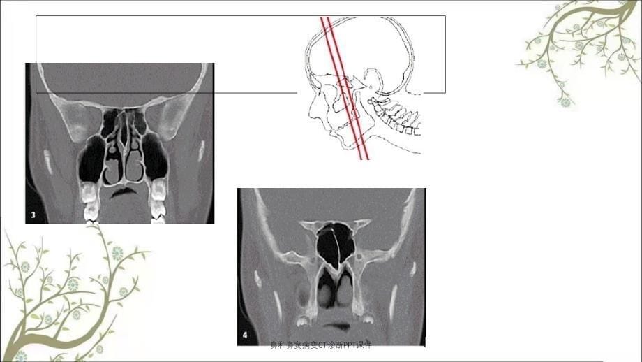 鼻和鼻窦病变CT诊断PPT课件_第5页