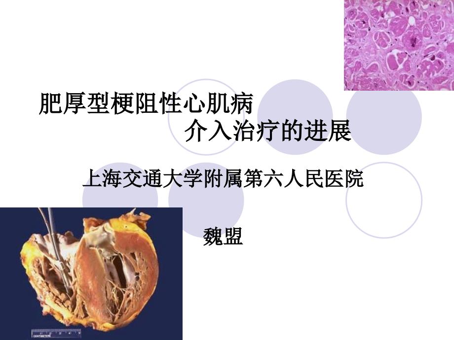 肥厚型梗阻心肌病介入治疗的进展教学_第1页