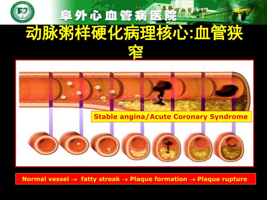 冠心病PCI术后抗栓治疗与出血输血及预后_第4页