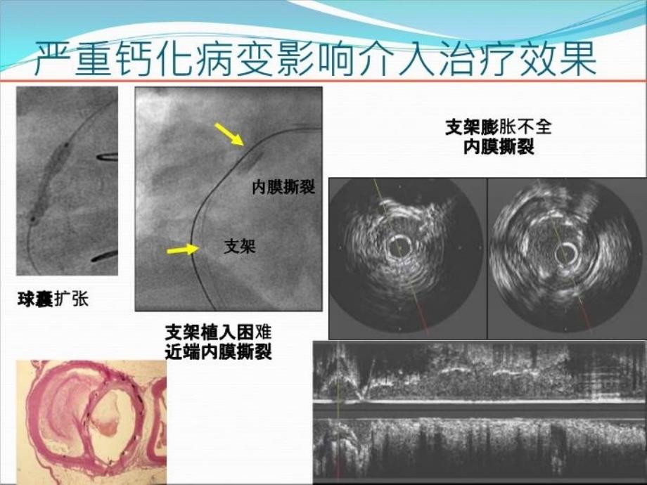 最新大庆油田总医院心内科温尚煜教学课件_第4页