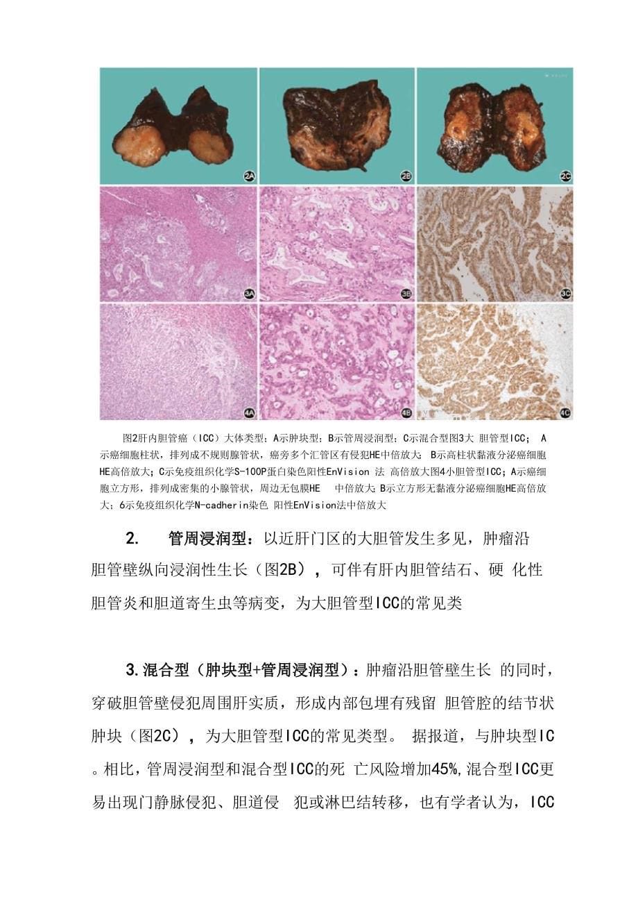 肝内胆管癌病理诊断专家共识_第5页