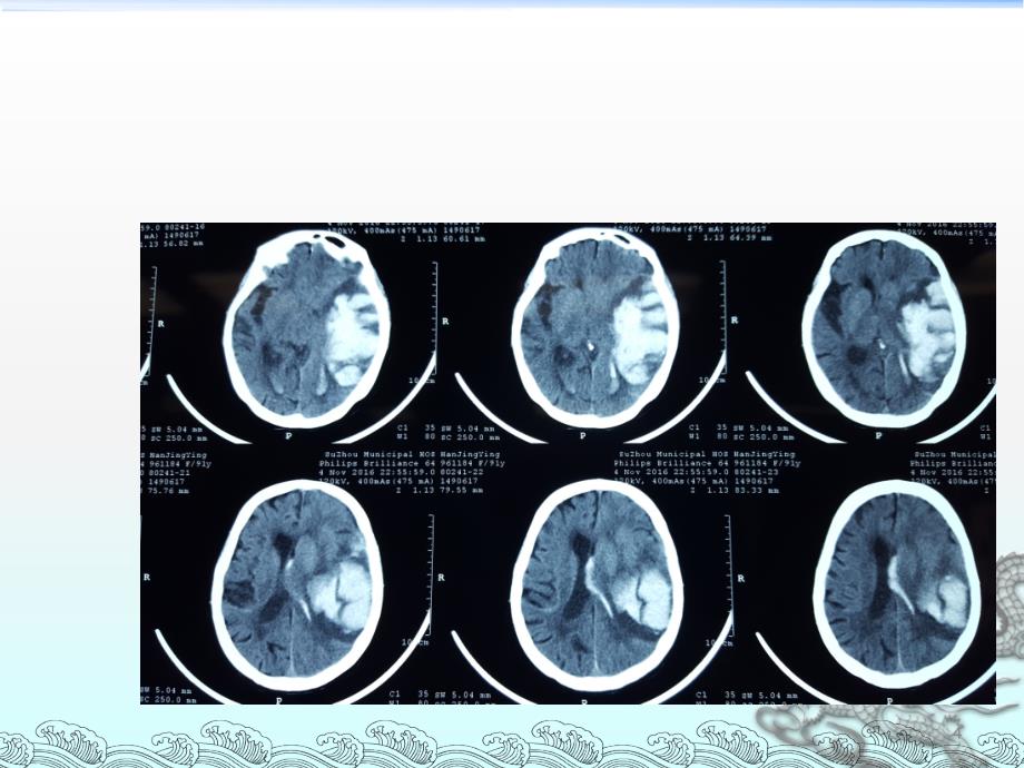 危重患者静脉血栓栓塞症预防策略ppt课件_第4页