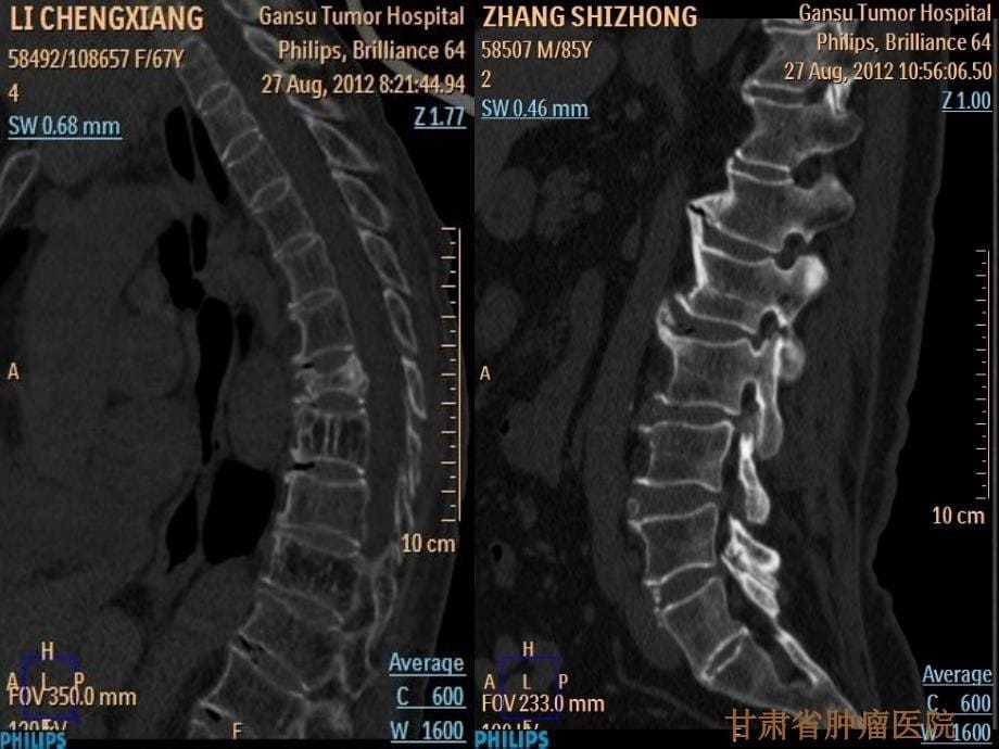 椎体病变的CT诊断_第5页