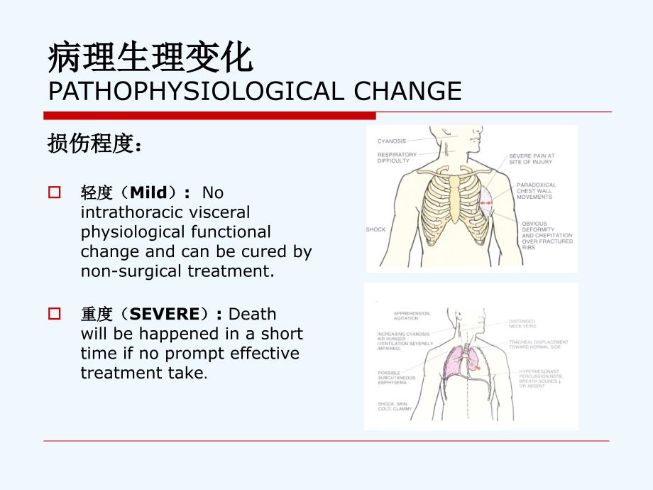 张力性气胸课件_第4页