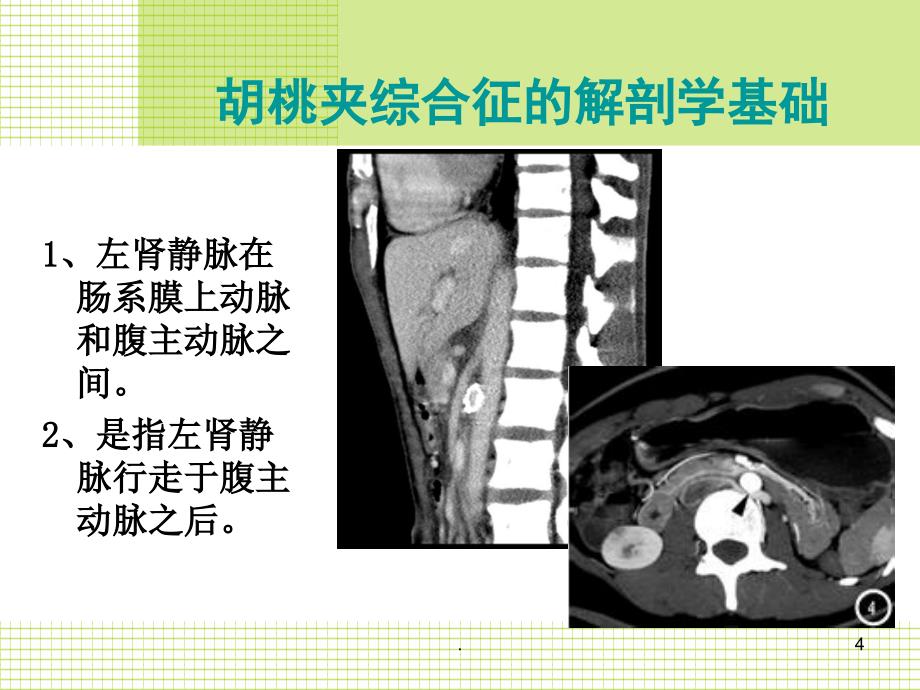 胡桃夹综合征最新ppt演示课件_第4页