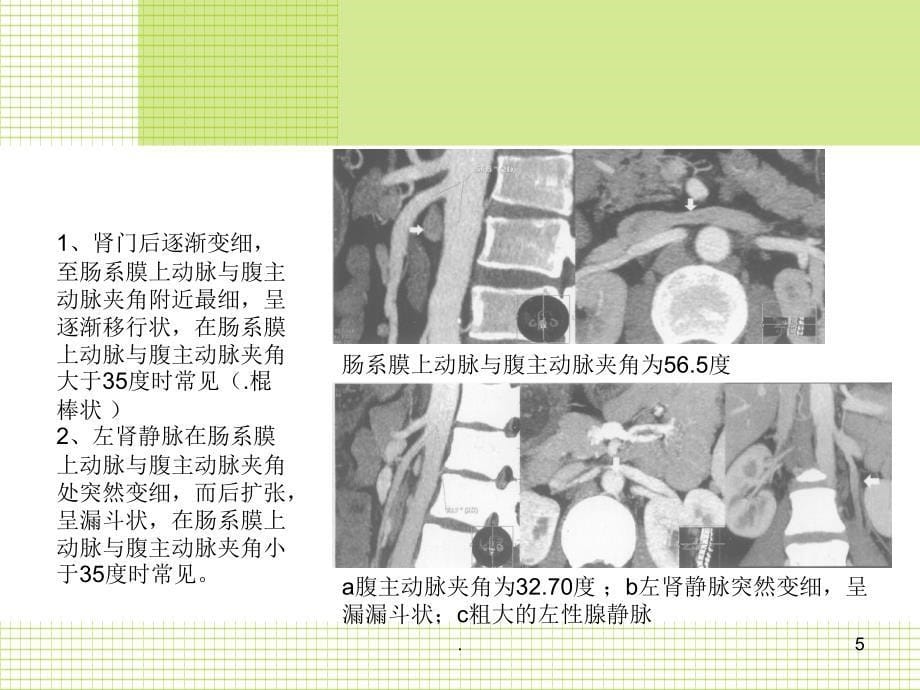 胡桃夹综合征最新ppt演示课件_第5页