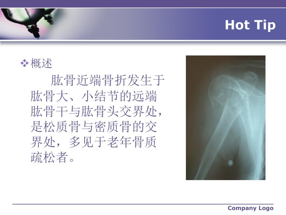 肱骨近端骨折的护理课件_第3页