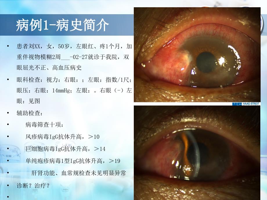 角膜内皮炎的诊断与治疗体会_第2页