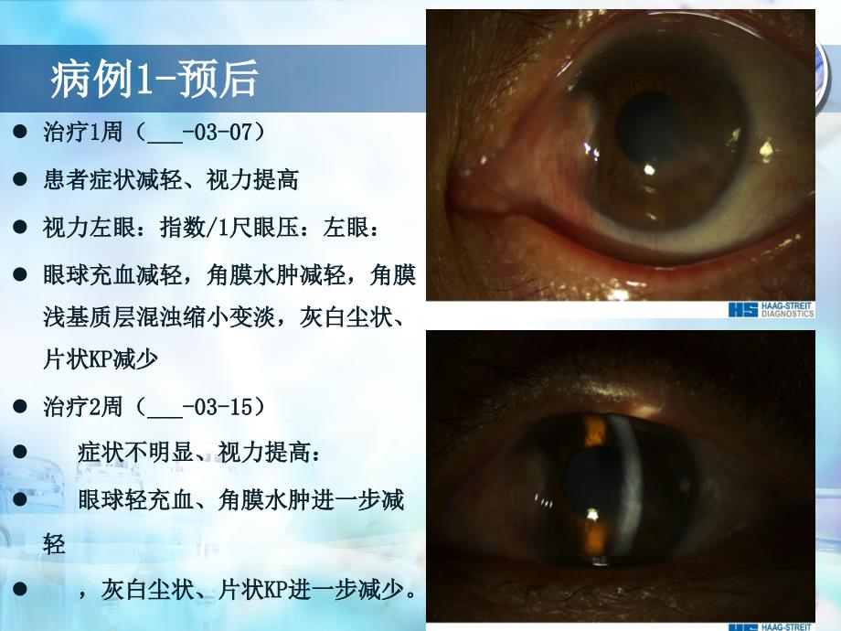 角膜内皮炎的诊断与治疗体会_第5页