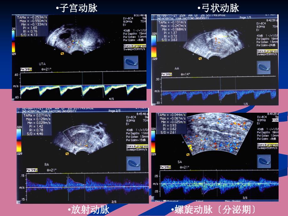 滋养细胞疾病超声诊断2ppt课件_第2页