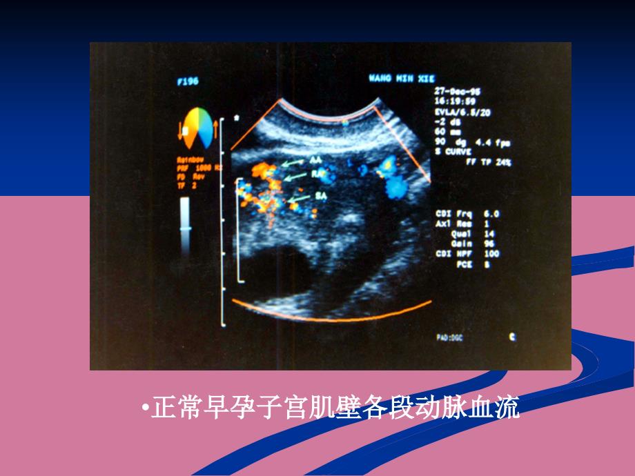 滋养细胞疾病超声诊断2ppt课件_第4页