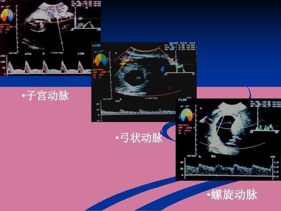 滋养细胞疾病超声诊断2ppt课件_第5页