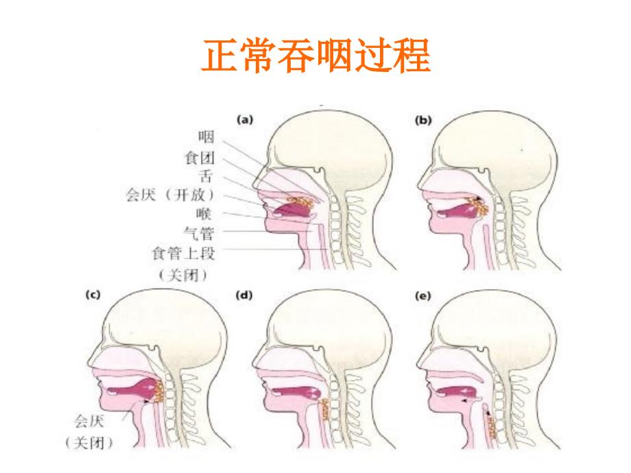 吞咽障碍护理.t_第2页